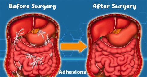 coronal margin adhesion|Abdominal Adhesions .